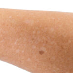 asarch blog which vitamin deficiency causes white spots on skin