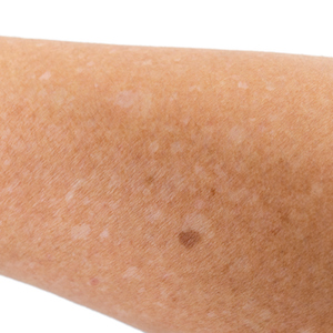 Which Vitamin Deficiency Causes White Spots on Skin? - Asarch Dermatology