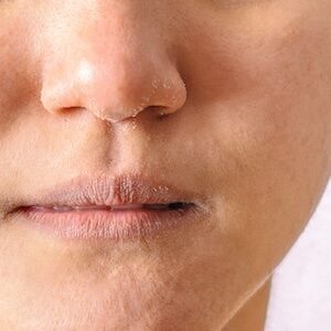 asarch blog common questions about skin dryness 72
